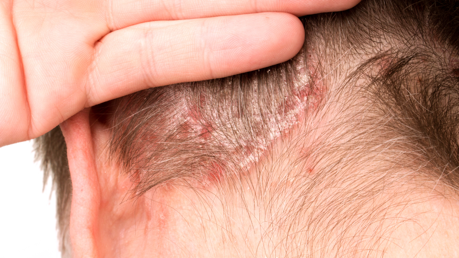 Psoriasis
