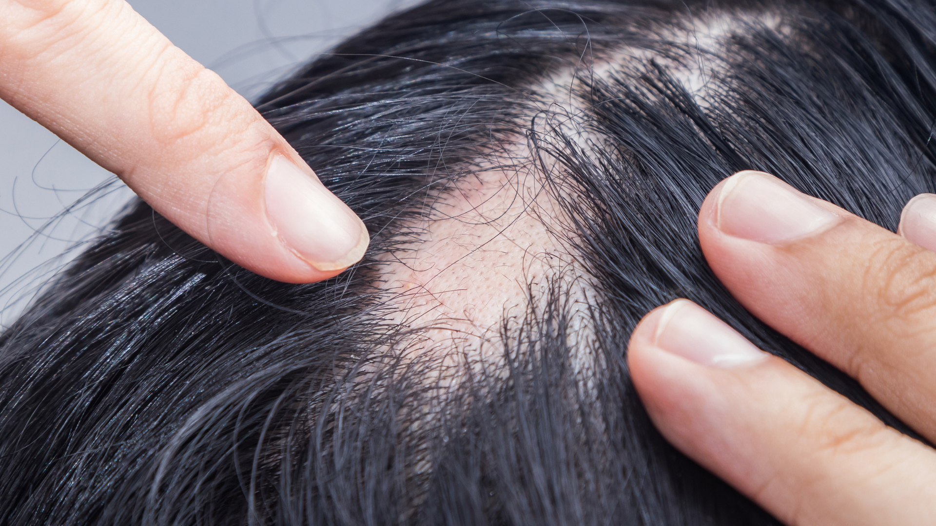 Alopecia