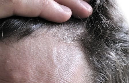 Berg hoofdhuid volwassenen shampoo