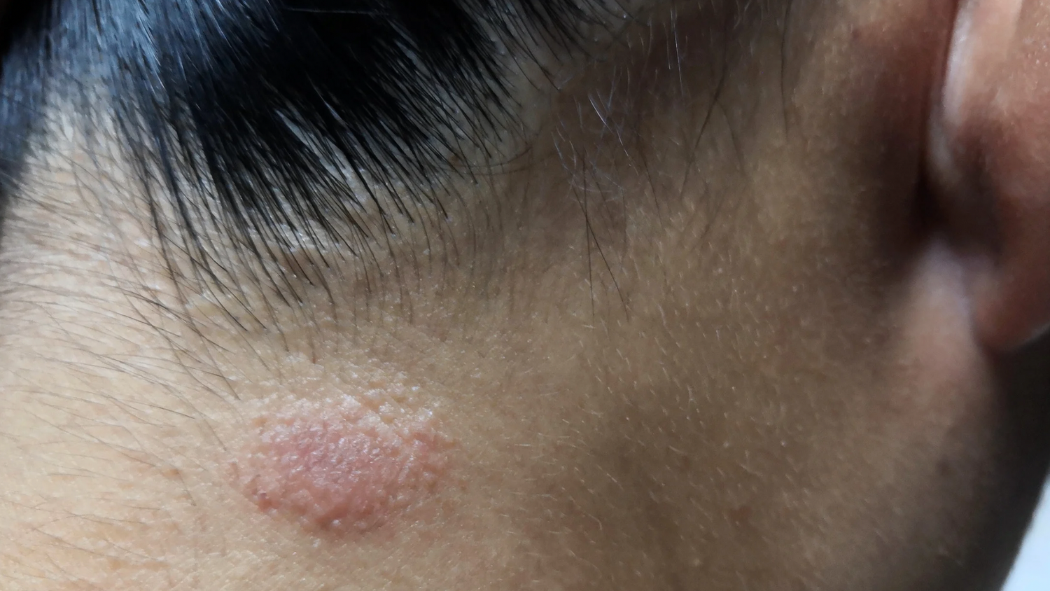 Tinea Captis